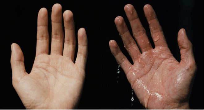 双手常年“湿漉漉”？别只当是“爱出汗”，可能是手汗症在困扰