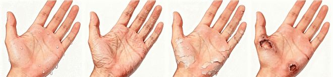 双手常年“湿漉漉”？别只当是“爱出汗”，可能是手汗症在困扰